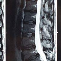 Check spelling or type a new query. Cauda Equina Syndrome