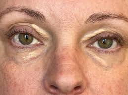 Image result for xantelasma