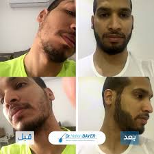 قبل وبعد زراعة الشعر Fictional Characters Character