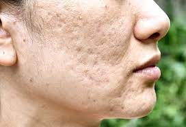 Acne scars before and after home remedies. How Do You Get Rid Of Acne Scars Naturally