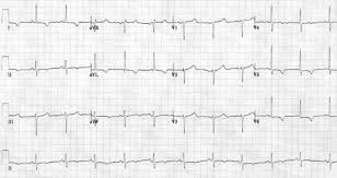 St depresi tipe horizontal dan down sloping adalah gambaran yang lumayan sering akan kamu tipe st depresi secara sederhana ditentukan dari kemiringan segmen st. Uap Unstable Angina Pectoris Dan Nstemi Non St Elevated Myocardial Infarction Kardiologi Caiherang