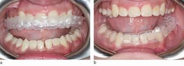 Maybe you would like to learn more about one of these? Removable Orthodontic Retainers Practical Considerations British Dental Journal