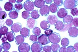Infectious mononucleosis (mono) is often called the kissing disease. Long Covid Symptoms Likely Caused By Epstein Barr Virus Reactivation Healthcare In Europe Com