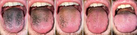 Image result for black hairy tongue symptoms