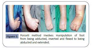 Ignacio ponseti was an american surgeon who described this method. Cross Sectional Study Of Clinical Profile And Treatment Of Clubfoot By Ponseti Method Among Infants At A Tertiary Care Hospital Insight Medical Publishing