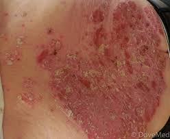 Image result for Auspitz Sign