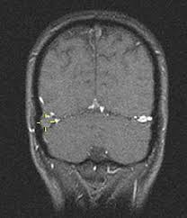 El seno cavernoso o tsc es una condición muy rara, pero puede afectar a adultos y niños, y puede ser mortal. Trombosis Del Seno Venoso Cerebral Wikipedia La Enciclopedia Libre