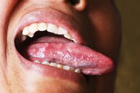 Pequenas Burbujas En La Lengua Causas