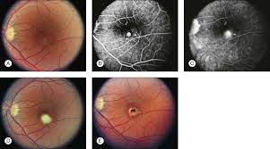 Ocular Histoplasmosis An Overview Sciencedirect Topics