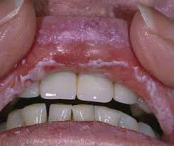 Image result for oral thrush symptoms roof of the mouth