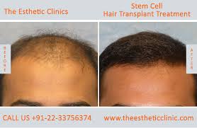 Can hair treatment or hair transplantation be realized with stem cells? Stem Cells Treatment Mumbai Stem Cells Therapy Cost India The Esthetic Clinics