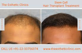 Stem Cells Treatment Mumbai Stem Cells Therapy Cost India The Esthetic Clinics