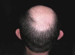 There have been an increase in number of young females showing up with excessive hair growth diagnosed with polycystic ovarian disease. Hair Loss Explained How And Why Men Go Bald The Independent The Independent