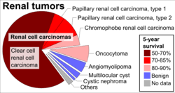 Kidney, or renal, cancer refers to any cancer that involves the kidney. Renal Cell Carcinoma Wikipedia