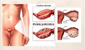 Sindrome Dos Ovarios Policisticos Sop E Infertilidade Fivmed