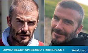 David Beckham Hair Transplant