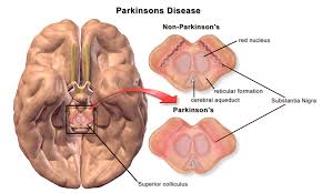 This technique allows doctors to see detailed pictures of the brain's dopamine system. Pathophysiology Of Parkinson S Disease Wikipedia
