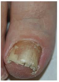 Image result for onychomycosis