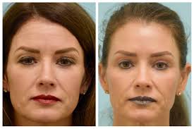 This Woman Is Shown Before And After An Upper Blepharoplasty Upper Eyelid Eyelid Surgery Upper