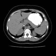 Splenic Granulomatous Disease Radiology Reference Article Radiopaedia Org