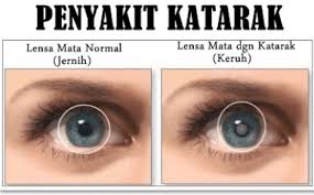 Otot siliar yang melekat pada lensa akan dapat mengubah bentuk lensa mata kamu. Jenis Jenis Cacat Mata Penyebab Dan Cara Mengatasinya