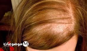 موضوعات دوت نت زراعة الشعر للنساء Hair Home Remedies Women