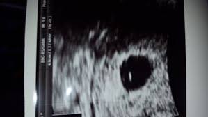 (im institut, zu hause) 2. 6 1 Ssw Komisches Foto Und Kein Herzschlag Forum Schwangerschaft Urbia De