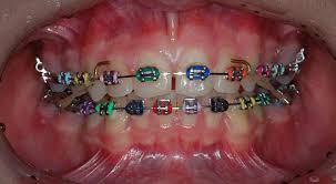 Learners starting study or training in 2021. Fixed Braces The Family Dentist Masterton Dental