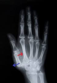 CMC Arthritis Orthosis in the Hand | CMC orthosis