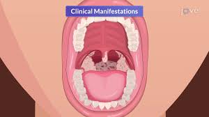 Image result for Pharyngitis