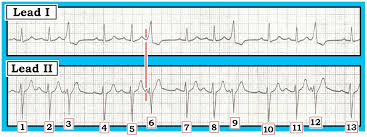 Additional learning materials include tutorials, practice strips and quiz. Ecg Interpretation Ecg Interpretation Review 67 Pac Pvc 12 Leads Better Than One
