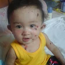 YOU ARE INVITED TO HELP SAVE BABY MARK! Baby Mark is in severe pain and  could die because his skin is blistering off from severe EB disease. Please  consider donating today!