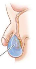 Possible signs of testicular cancer include: Penile And Scrotal Disorders Flashcards Quizlet