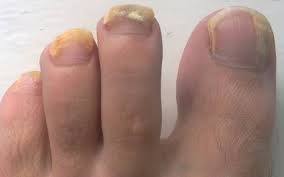 Using Hydrogen Peroxide For Toenail Fungus Cure Home Remedy