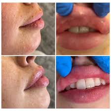 Dermal Fillers | Dr. Michael J. Schenden