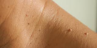 Skin Tags Identification And Removal Insider