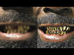 How could you pull out teeth from so many bodies so quickly? Can You Get Gold Teeth On Chipped Tooth Youtube