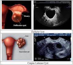 Treatment depends upon the cause and type. Detection Of Ovarian Cyst In Ultrasound Images Using Fine Tuned Vgg 16 Deep Learning Network Springerlink