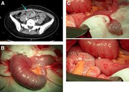 The ovaries often lie within the lower quadrants of the abdomen. Sausage Like Mass In Lower Abdomen Gastroenterology