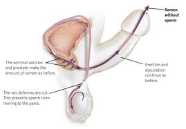 Image result for Vasectomy