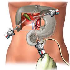The biliary tract comprises of gallbladder and intra and extrahepatic biliary tree. Dr Amit Dutt Dwary Biliary Tract Cancer Kolkata India Cancer Surgery Onco Surgery Biliary Tract Cancer Doctor Cholangiocarcinoma In Kolkata Low Cost Best Top Specialist In At For Treatment Doctor