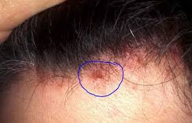 Pin By Holly On Fitness In 2020 Pimples On Scalp Pimples Scalp Bumps