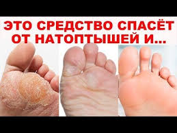 как избавиться от мозолей на ступнях в домашних условиях V Etom Video My Vam Pokazhem Prekrasnoe Sredstvo Dlya Pyatok Ot Natoptyshej Zagrubevshej Kozhi I Pri Drugih Kozhnyh Izmeneniyah B Zdorove Varikoz Zdorove I Krasota