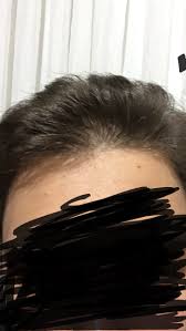 saclarim cok dokuluyor ne yapmaliyim sac hekimim