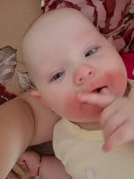 Buna ziua! Fetita mea e suspecta de alergie la proteina din lapte. Are 5  luni. Simptome scaun cu mucus. Este alaptata.ce vroiam sa întreb? Alergia  asta trece sau asa rămâne mereu?mulțumesc. |