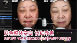 变黑到长斑是一个连续的过程推荐VG滤镜+美白搭配一起服用👉一款“遮瑕”，淡化已生成淡斑👉一款“粉底”，杜绝肌肤变黑#