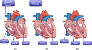 Image result for Restrictive Cardiomyopathy