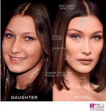 Maybe you would like to learn more about one of these? Dr Bhabha Aesthetics A Twitter Before And After With Fillers Bella Hadid S Face As A Young Girl And As A Model With Fillers We Don T Ever Want To Change You Rather Help