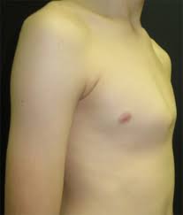 Find the perfect the front ribs and shoulder stock photo. Chest Wall Lumps Rib Injury Clinic
