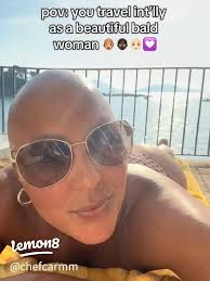 Embracing Baldness: My Journey with Alopecia